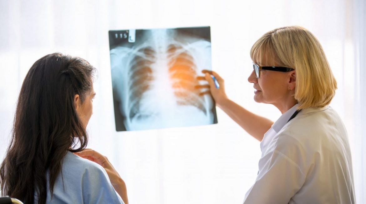 Post-Lung Cancer Surgery: Key Considerations for Patients